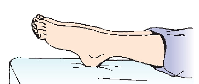 Foot pointed like a plantar-flexed ballerina during sleep